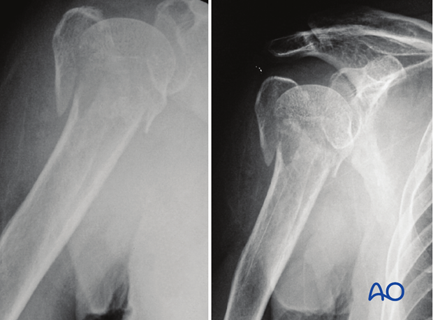 4-Part fracture with intact articular surface and valgus malalignment