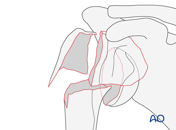 4-part fracture, marked displacement, intact articular surface, varus malalignment
