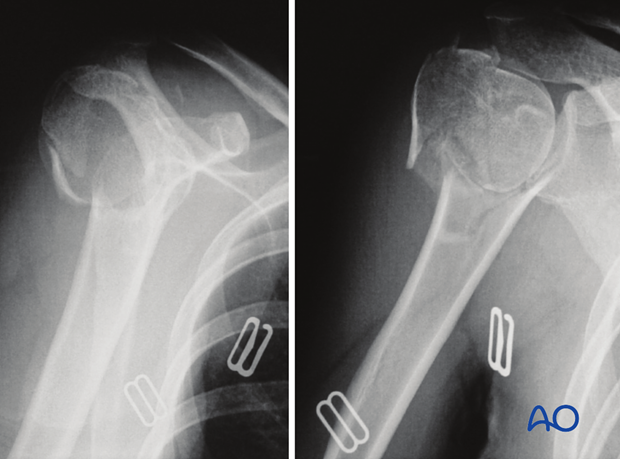 4-Part fracture with intact articular surface and varus malalignment