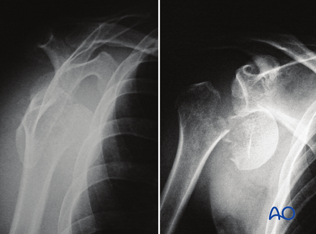 Isolated anatomical neck fracture with glenohumeral dislocation