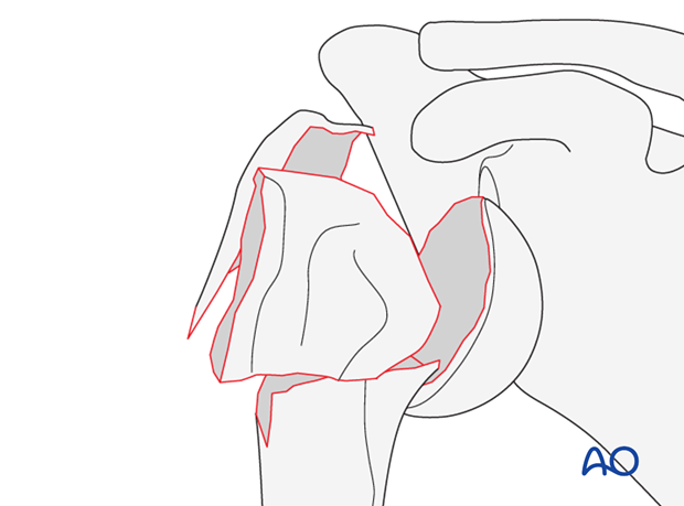 4-Part fracture, simple metaphyseal fracture with intact articular surface