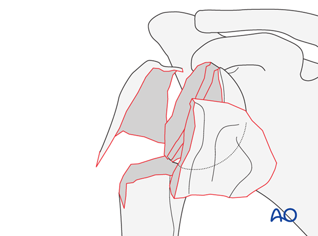 4-Part fracture, fragmentary metaphyseal fracture +/- fragmentary articular surface