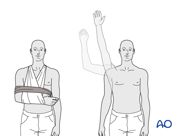 Nonoperative treatment should provide mechanical support until the patient is sufficiently comfortable to begin shoulder use ...