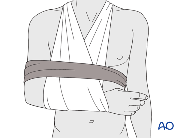 Optimal shoulder immobilization is achieved when the upper arm and forearm are secured to the chest. Traditionally, this has ...