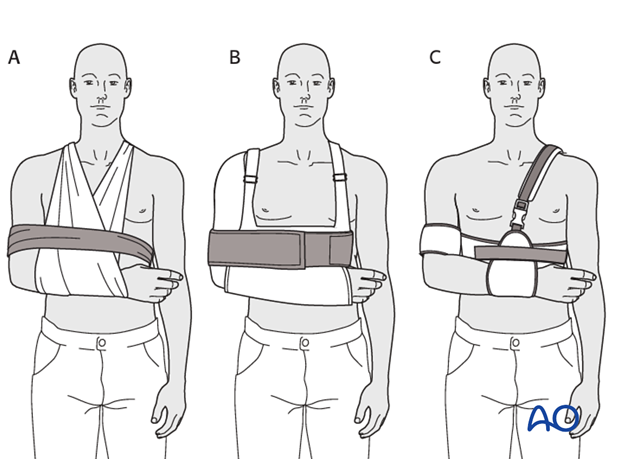 Sling and swath (A), shoulder immobilizer (B), Gilchrist bandage (C), and other such devices all provide essentially similar ...