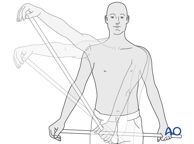 An exercise bar, which lets the patient use the uninjured left shoulder to passively move the affected right side.