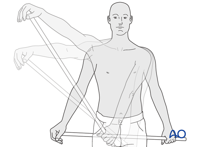 Nonoperative for Extraarticular 3-part, surgical neck and greater ...