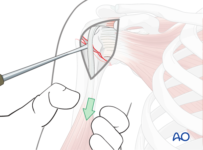 ORIF - Plate fixation for Extraarticular 2-part, surgical neck, impaction