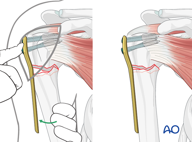 The plate is used as a handle to reduce the humeral head towards the shaft.