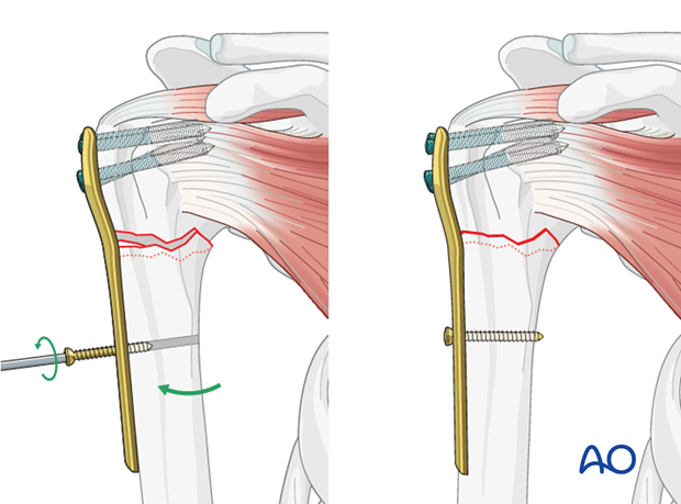 Once preliminary reduction is achieved a bicortical non-locking screw inserted through the elongated hole.