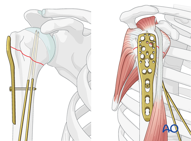 Attach the plate to the humeral shaft with a bicortical small fragment 3.5 mm screw inserted through the elongated hole. 