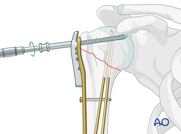 Insert a locking-head screw through the screw sleeve into the humeral head. 