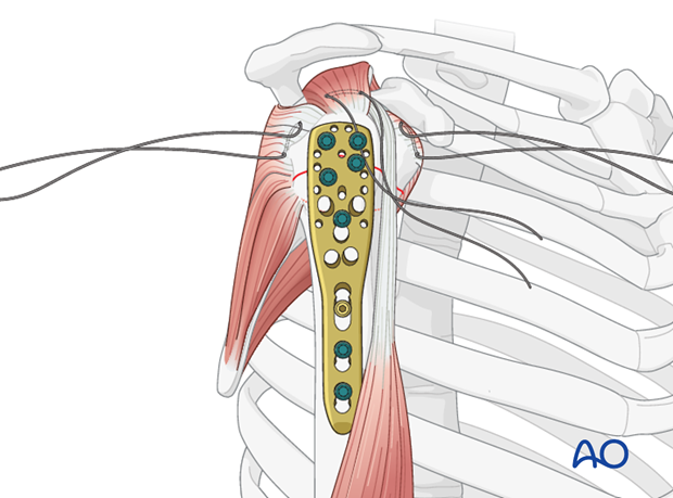 Consider adding tension band sutures through the rotator cuff tendon insertions and appropriate holes in the plate. 