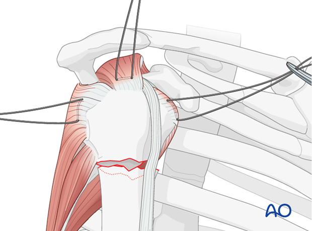 Insert holding sutures through the insertions of the subscapularis, supraspinatus, and infraspinatus tendon.