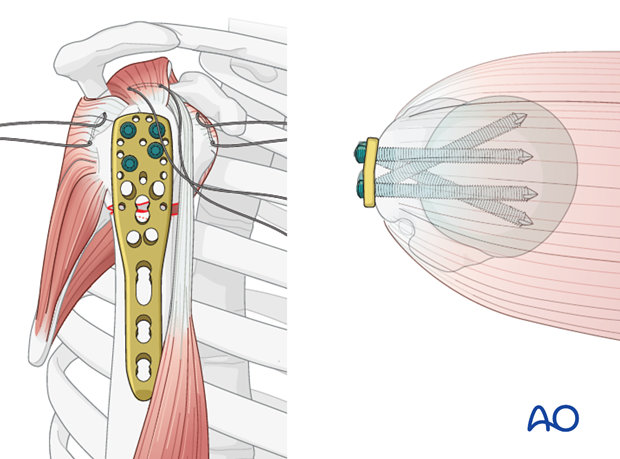 Place a sufficient number of screws into the humeral head.