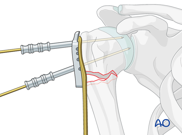 If the plate is properly positioned, the screws will be placed correctly in the humeral head.