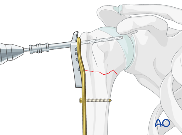 Use an appropriate sleeve to drill holes for the humeral head screws. 