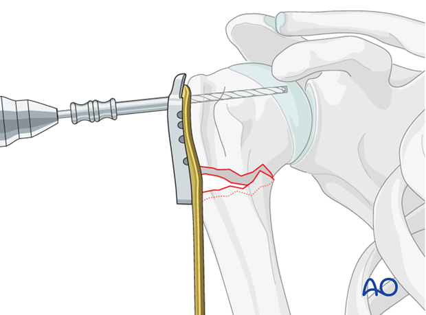 Use an appropriate sleeve to drill holes for the humeral head screws.