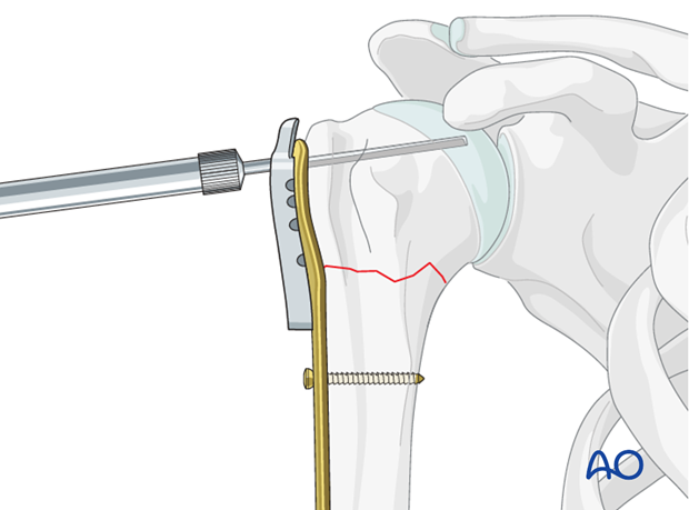 Determine screw length