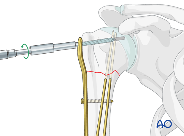 Insert a locking-head screw through the screw sleeve into the humeral head.