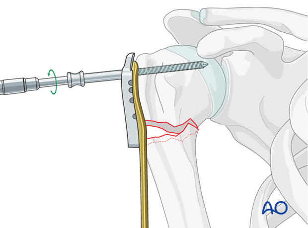 Insert a locking-head screw through the screw sleeve into the humeral head.