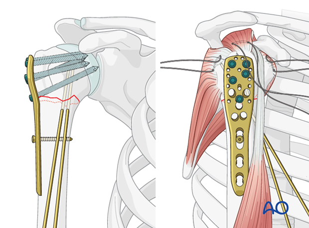 Place a sufficient number of screws (often 5) into the humeral head.