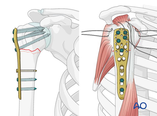 Insert one or two additional bicortical screws into the humeral shaft.