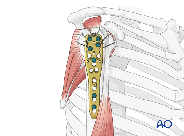 Secure the tendons of the rotator cuff with additional tension band sutures through the small holes in the plate.