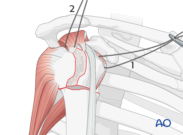 Rotator cuff sutures: Subscapularis and supraspinatus tendon