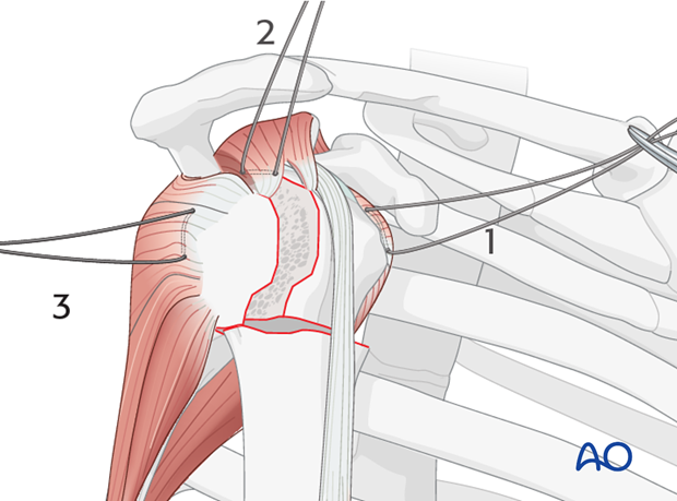 Infraspinatus tendon