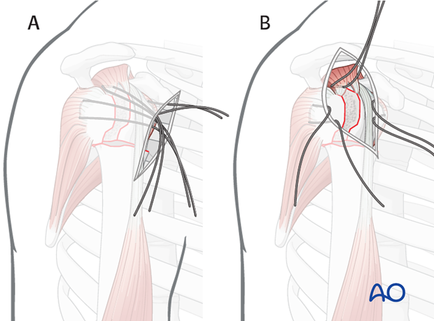 It is easier the further lateral of an approach is used. A) shows an deltopectoral approach and B) an anterolateral approach.