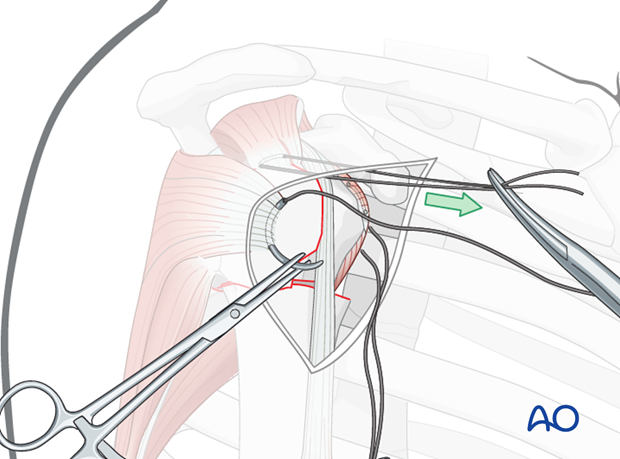 Insert a preliminary traction suture into the visible part of the posterior rotator cuff ...