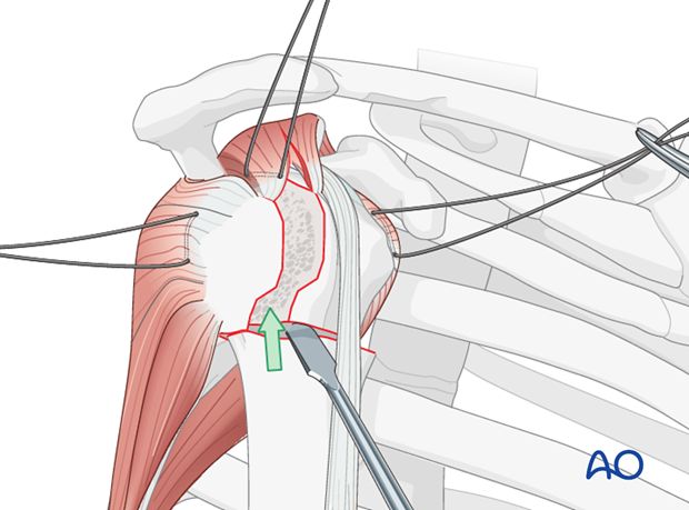 Correct the valgus impaction by elevating the the displaced proximal humeral segment.