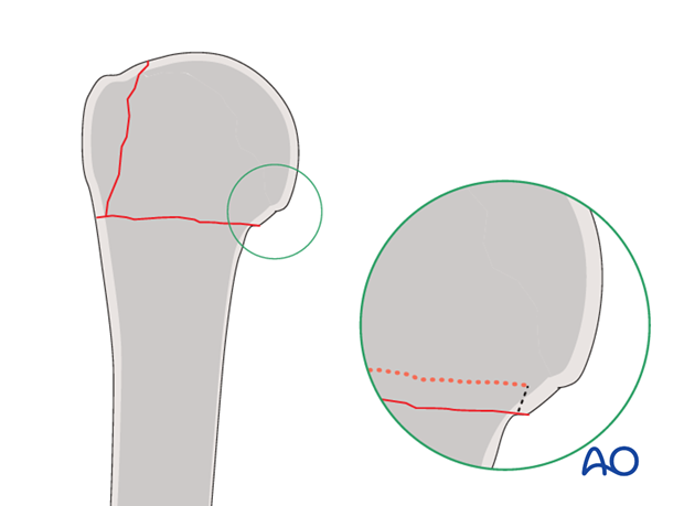 In osteoporotic bone, stability may be increased by leaving medial impaction of the humeral head.