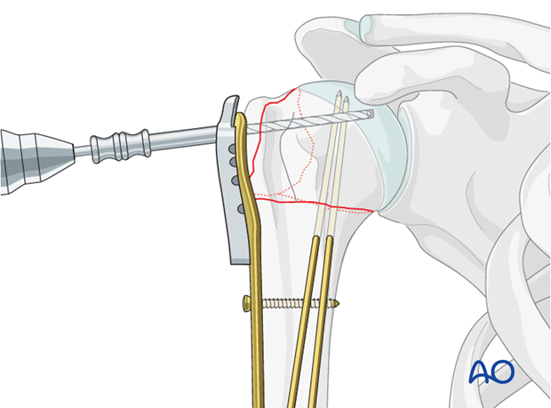 Use an appropriate sleeve to drill holes for the humeral head screws.