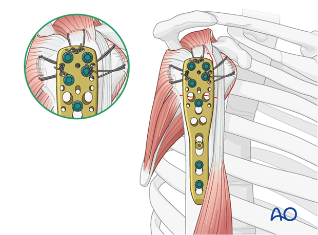 Sutures placed through the insertions of each rotator cuff tendon increase stability.