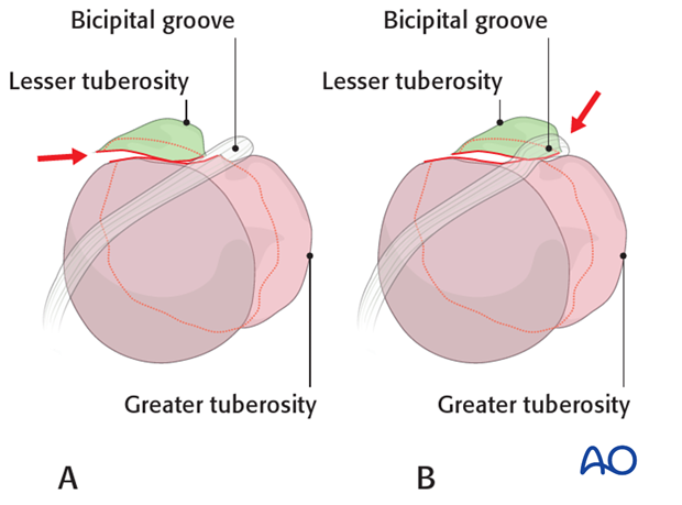 Lesser tuberosity, suture reduction and fixation
