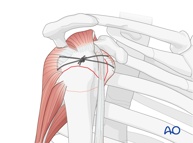 Orif - Plate Fixation For Extraarticular 3-part, Surgical Neck And 