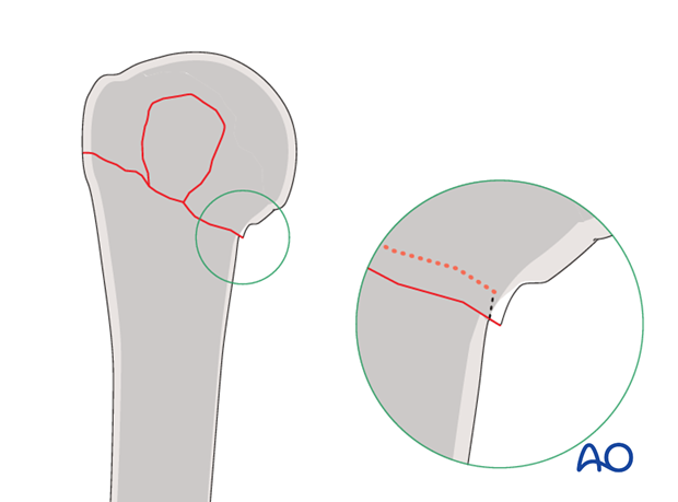 In osteoporotic bone, stability may be increased by leaving slight medial impaction of the humeral head