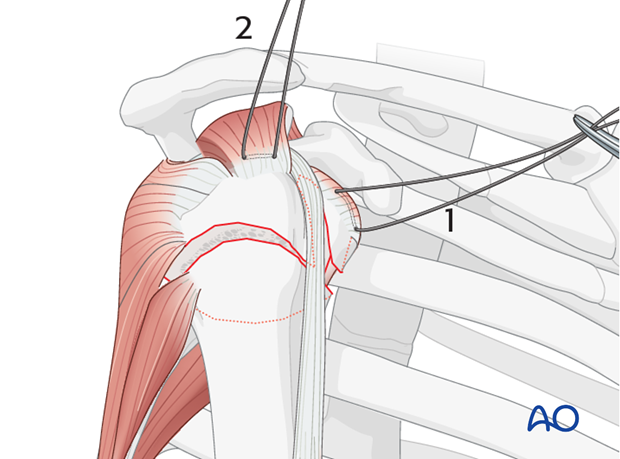 Rotator cuff sutures: Subscapularis and supraspinatus tendon