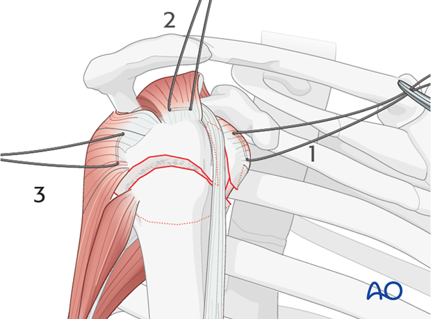 Next, place a suture into the infraspinatus tendon insertion (3).