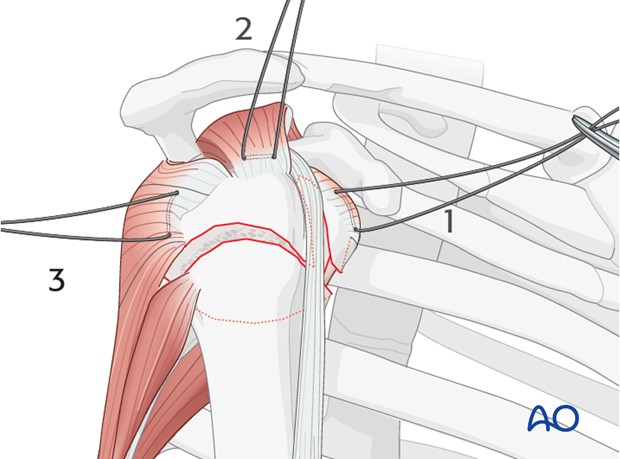 The rotator cable extends from lesser tubercle of humerus to greater