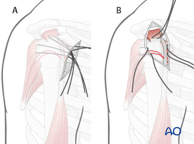 It is easier the further lateral of an approach is used. A) shows an deltopectoral approach and B) an anterolateral approach.