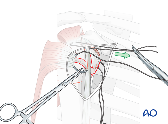 ORIF - Plate fixation for Extraarticular 3-part, surgical neck and ...