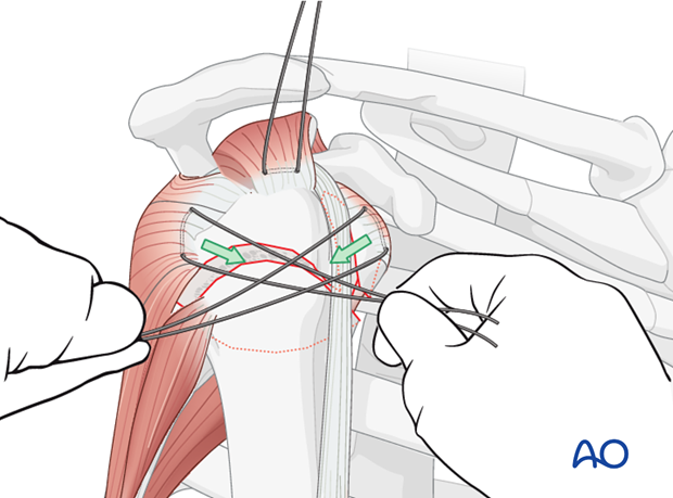 To reduce the lesser tuberosity, pull the sutures between the subscapularis and the infraspinatus horizontally ...