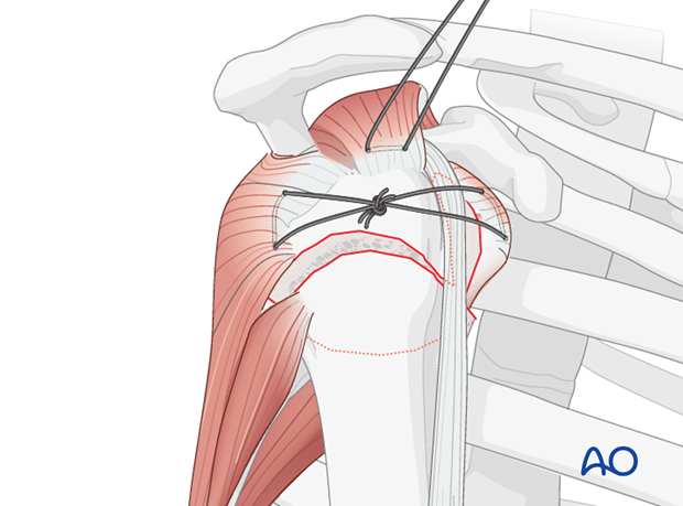 Reduce and fix the lesser tuberosity to the humeral head (thereby converting the 3-part fracture into a 2-part situation)