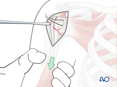 ORIF - Plate fixation for Extraarticular 3-part, surgical neck and ...