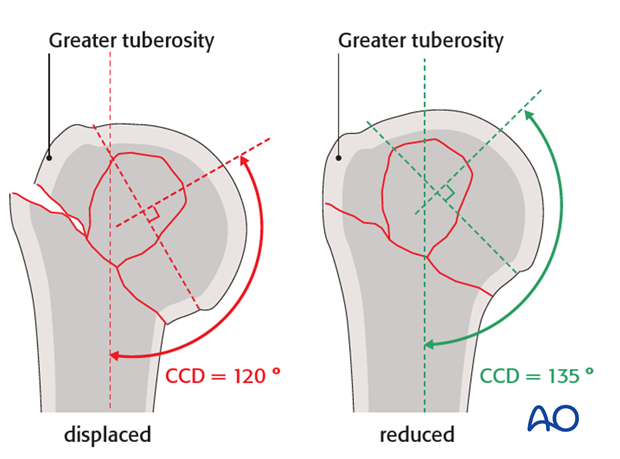 The centrum column diaphyseal (CCD) angle should be 135°.