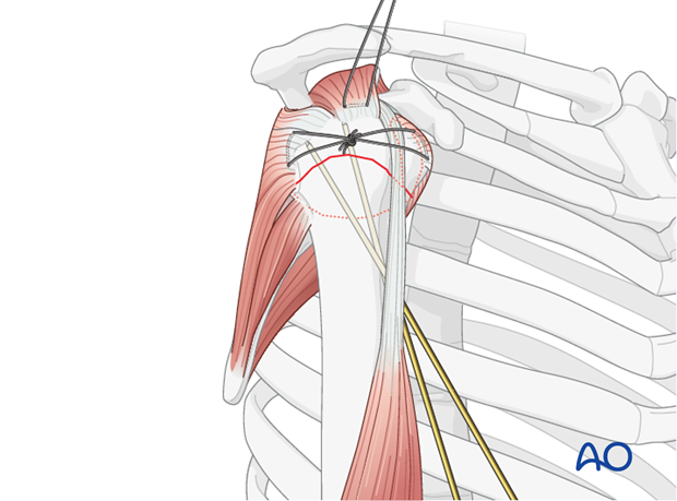 After its reduction, the humeral head is preliminarily fixed to the shaft using two K-wires.