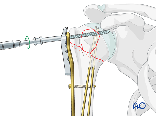 ORIF - Plate fixation for Extraarticular 3-part, surgical neck and ...